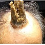   A 74-year-old Indian man, Shyam Lal Yadav, has grown a four-inch horn after he suffered a head injury in 2014.