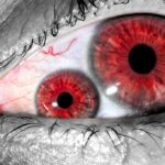 5 Rare and Bizarre Eye Conditions